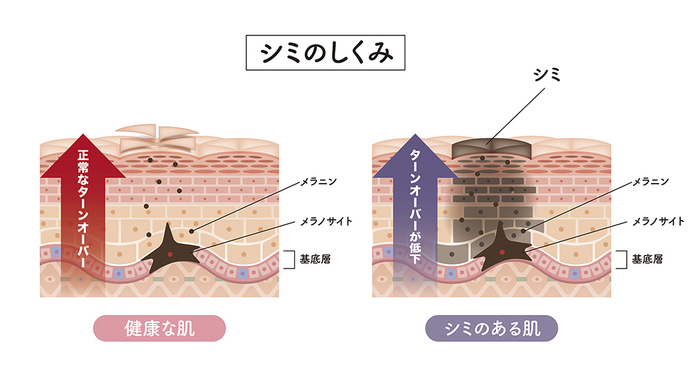 シミの改善