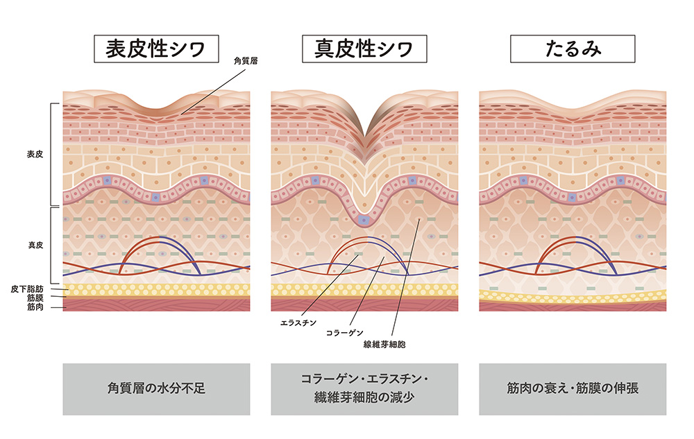 シワ・タルミの改善