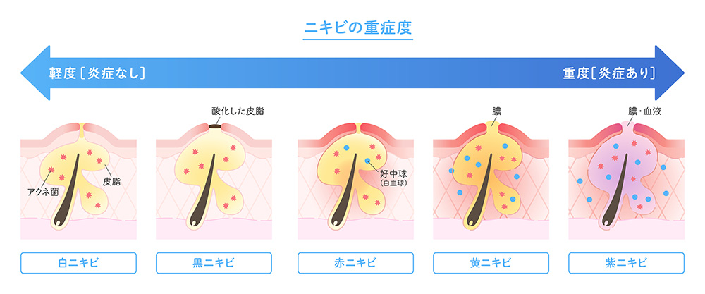 ニキビの改善